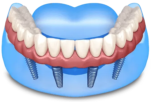 Permanent fixed PMMA/titanium teeth